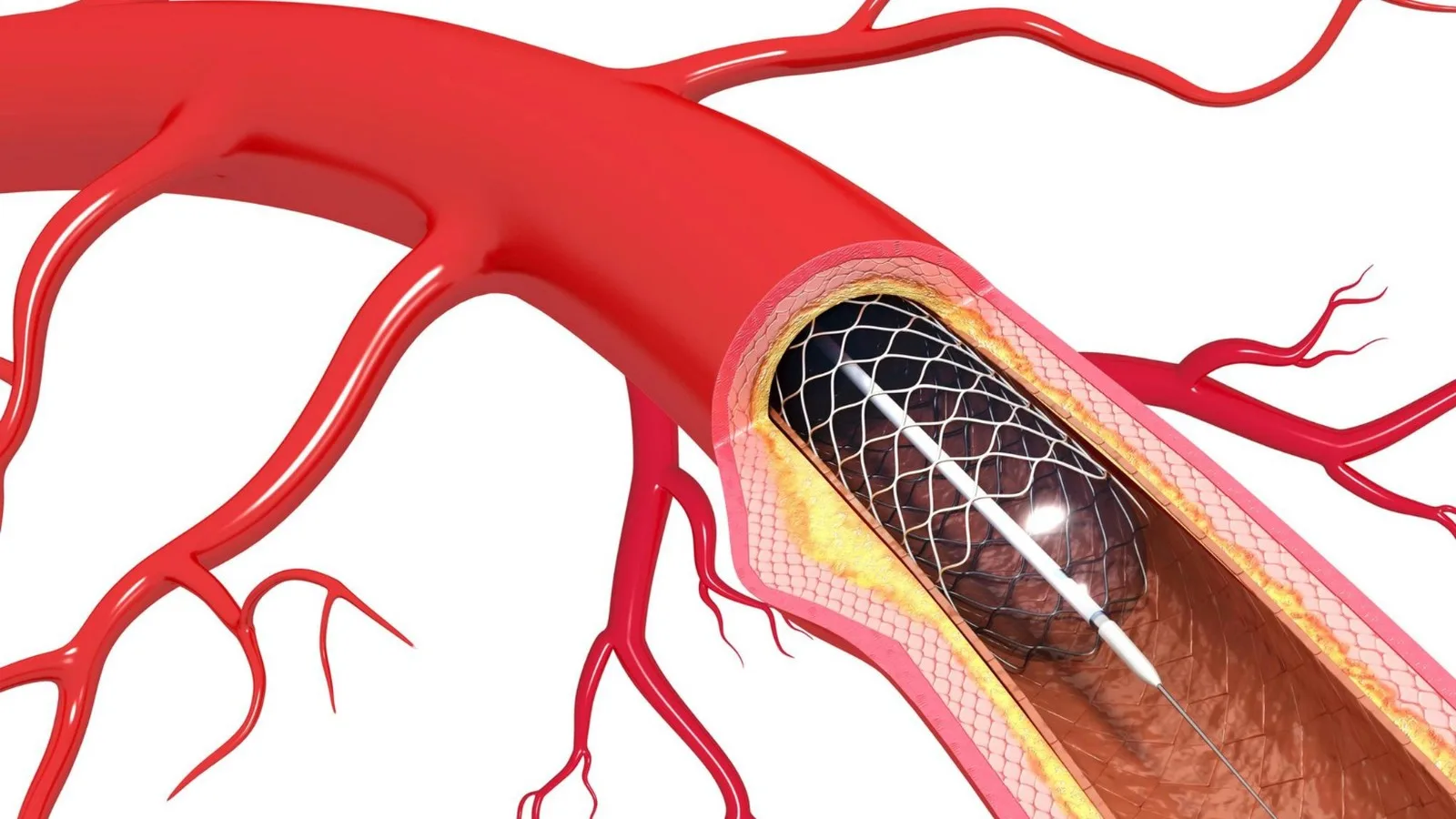 ¿Qué médico trata embolia arterial?
