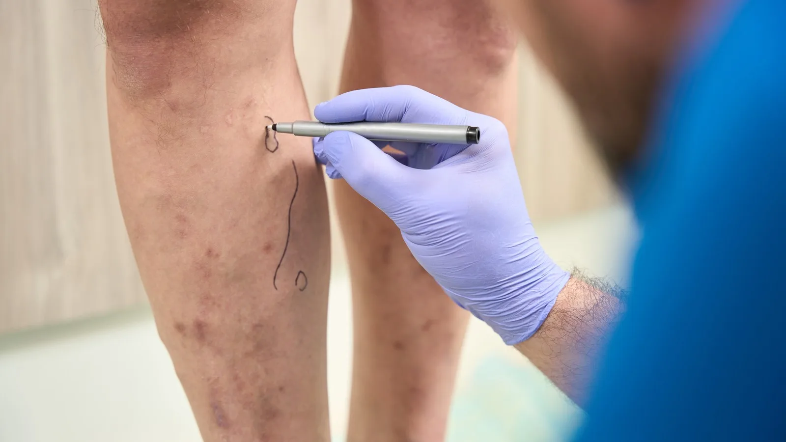 ¿Qué médico trata trombosis venosa profunda?