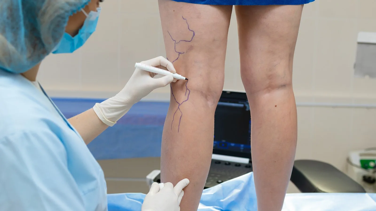 Abordaje Especializado de Úlceras Vasculares en CDMX